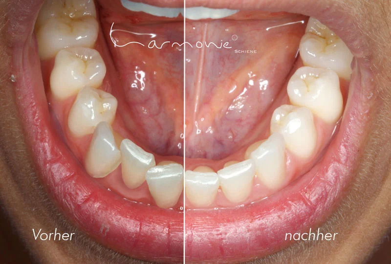 Aligner Harmonischiene von Orthos, Mund geöffnet